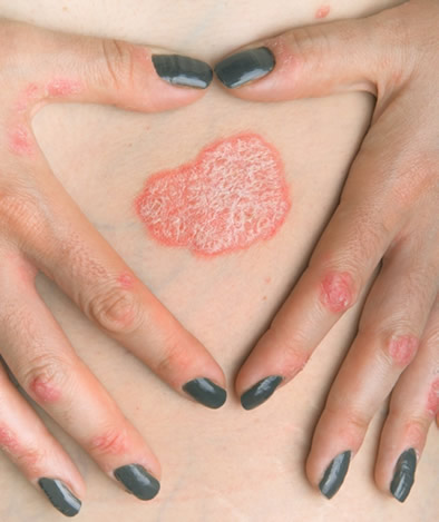 Psoriasis figuur 1