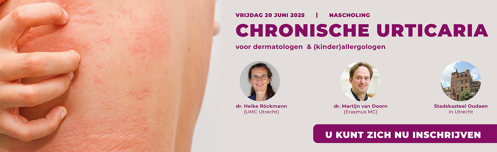Nascholing Chronische Urticaria